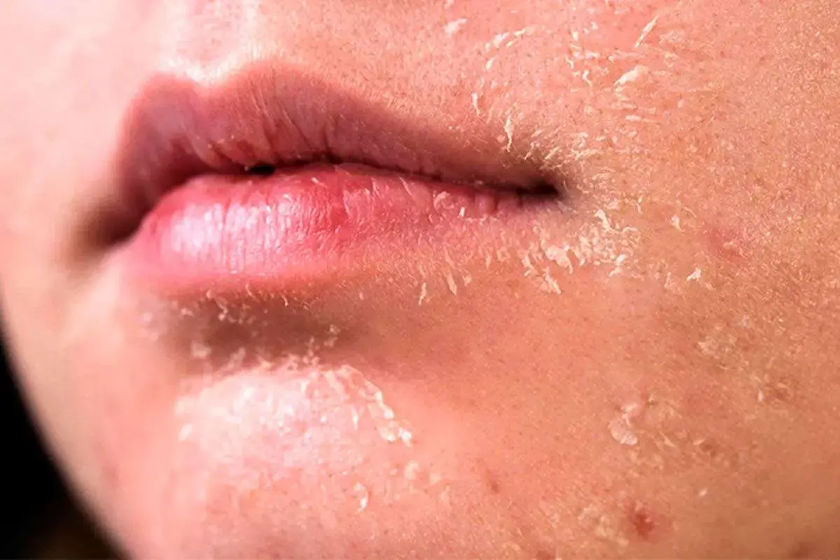 ۵ روش برای مراقبت از پوست در زمستان/ با این چند روش ساده پوست براق و لطیف داشته باشید