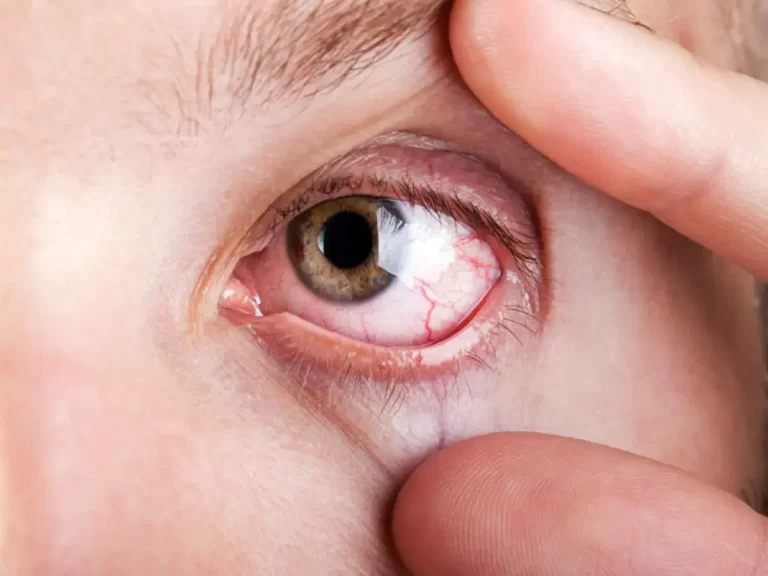 راهکار‌های طلایی برای جلوگیری از خشکی چشم در هوای سرد زمستان