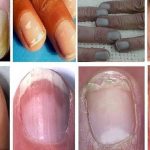 ۷ علامت هشداردهنده کلسترول بالا در ناخن/ هشدار جدی برای سلامتی بدن