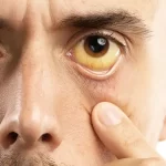 ۵ علامت هشداردهنده کبد چرب روی صورت