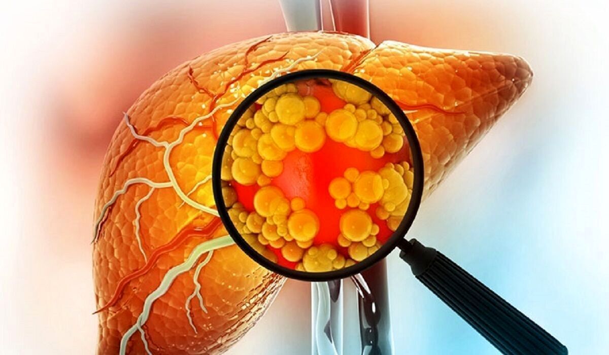 تنها راه قطعی درمان کبد چرب را بشناسید