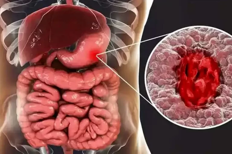اصلی ترین عامل بروز زخم معده شناسایی شد