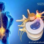 علائم دیسک کمر چیست؟ اصلی ترین نشانه های دیسک کمر از نظر دکتر محمدرضا شاه محمدی