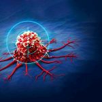 مراقب 5 سرطان شایع در ایران باشید