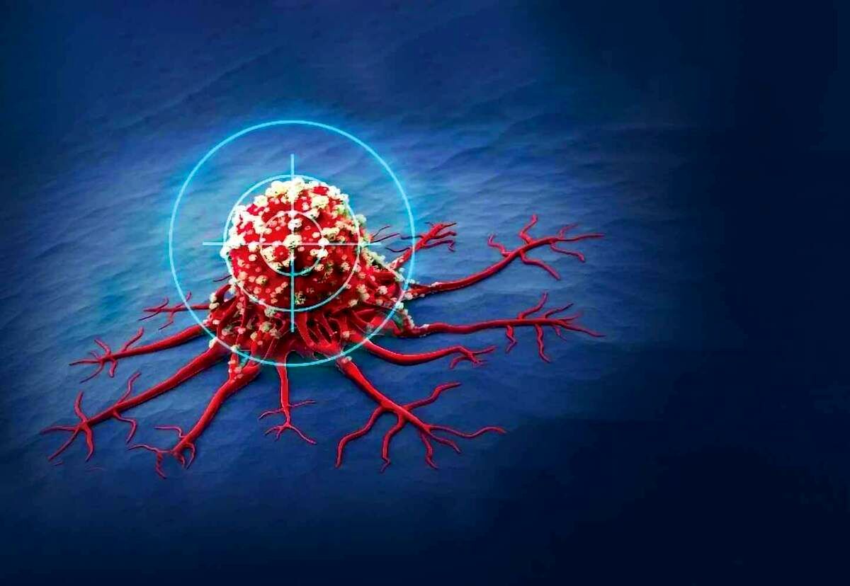  مراقب 5 سرطان شایع در ایران باشید